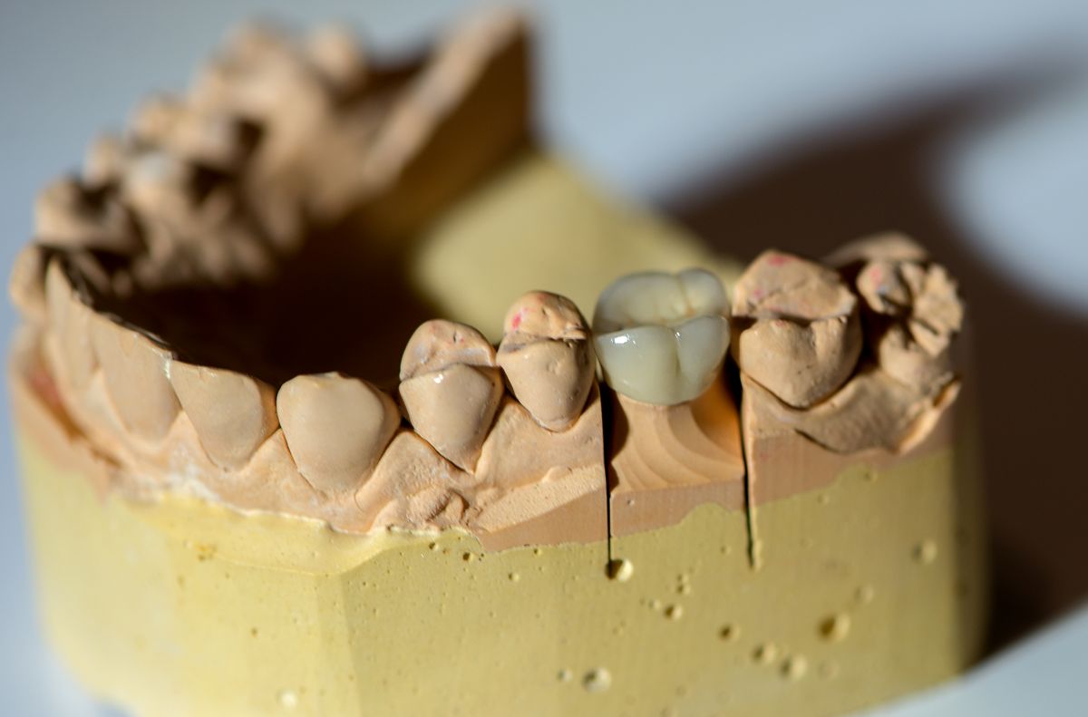 Close-up of an upper dental model with a gray crown placed on one tooth among natural-looking teeth on a pink gum surface.