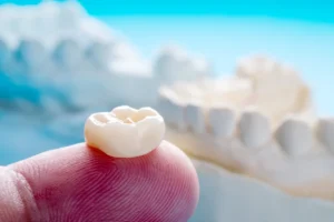dental crown in encino - Encino Gentle Dental